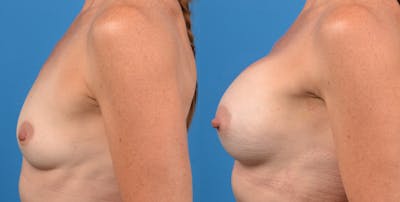 Breast Augmentation Before & After Gallery - Patient 14778322 - Image 2