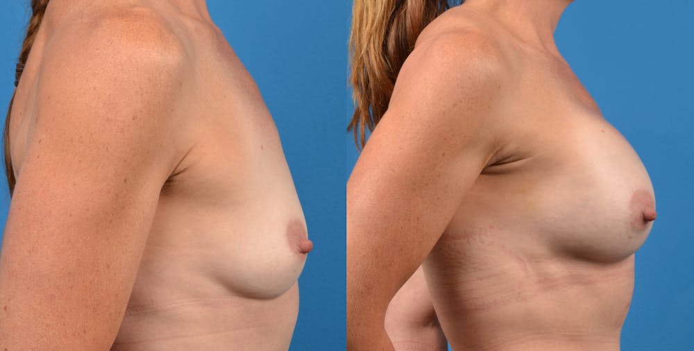 Breast Augmentation Before & After Gallery - Patient 14778322 - Image 3