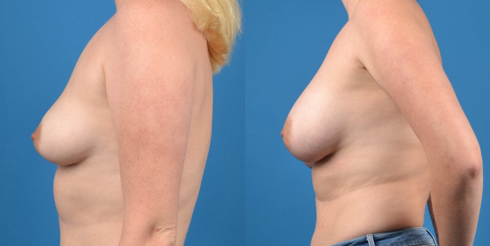 Breast Augmentation Before & After Gallery - Patient 14778609 - Image 2