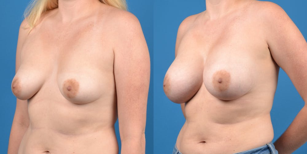 Breast Augmentation Before & After Gallery - Patient 14778609 - Image 3