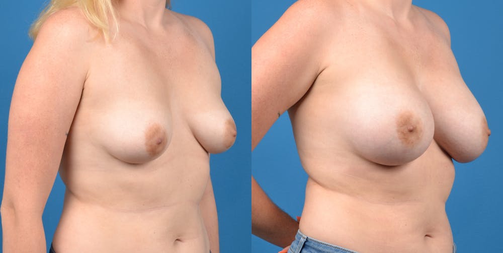 Breast Lift Before & After Gallery - Patient 14282524 - Image 4