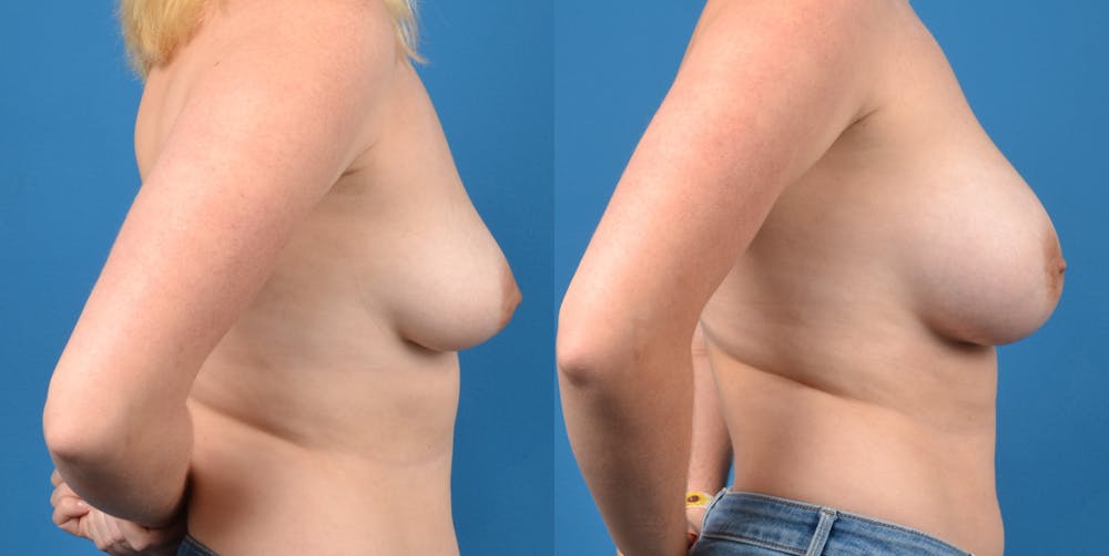 Breast Lift Before & After Gallery - Patient 14282524 - Image 5