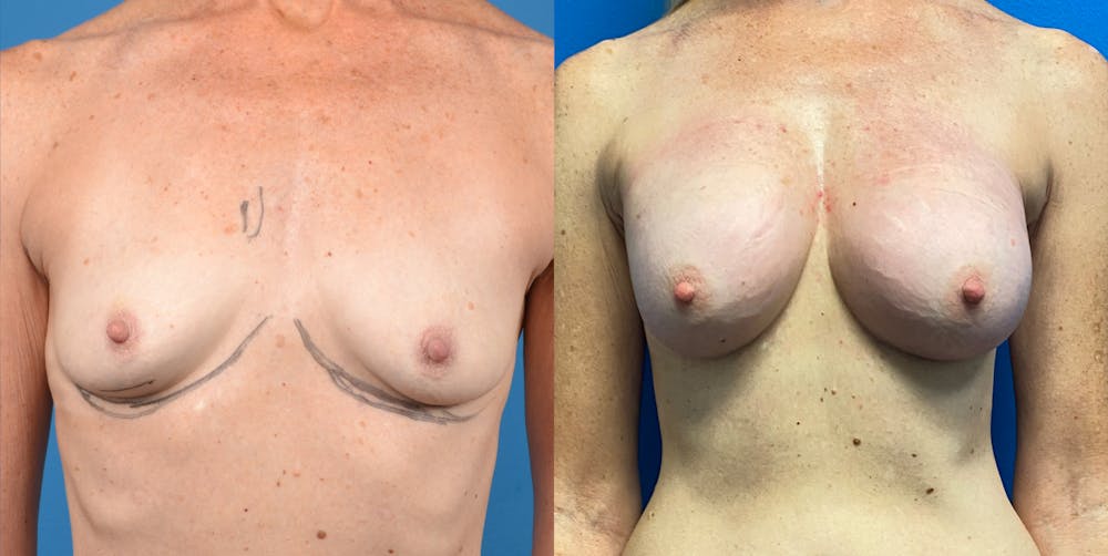 Breast Augmentation Before & After Gallery - Patient 14778673 - Image 1