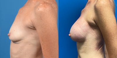 Breast Augmentation Before & After Gallery - Patient 14778673 - Image 2