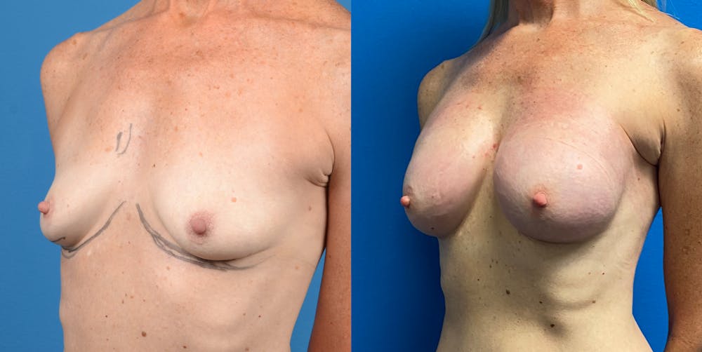 Breast Augmentation Before & After Gallery - Patient 14778673 - Image 3