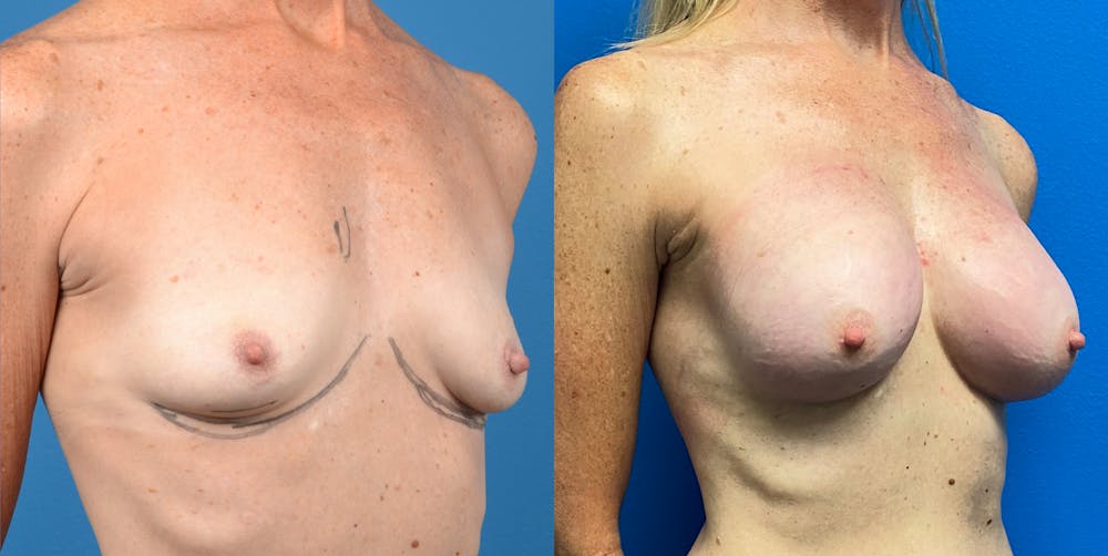 Breast Augmentation Gallery - Patient 14778673 - Image 4