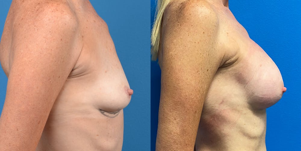 Breast Augmentation Before & After Gallery - Patient 14778673 - Image 5