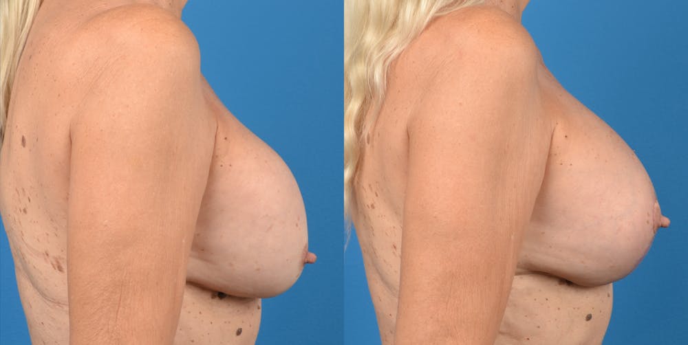 Breast Lift Gallery - Patient 14778919 - Image 2