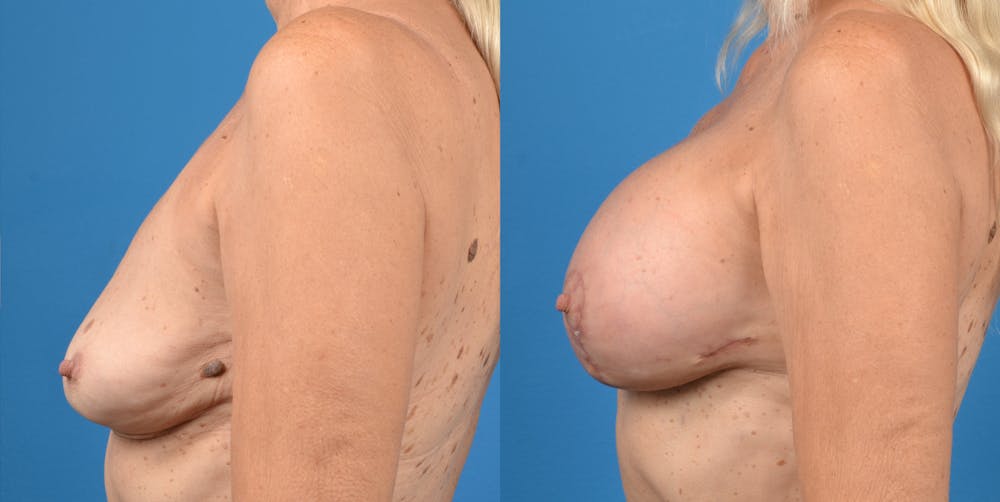 Breast Lift Before & After Gallery - Patient 14778919 - Image 3