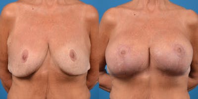 Breast Revision Before & After Gallery - Patient 14778924 - Image 1