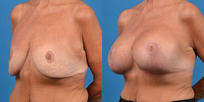Breast Revision Before & After Gallery - Patient 14778924 - Image 2