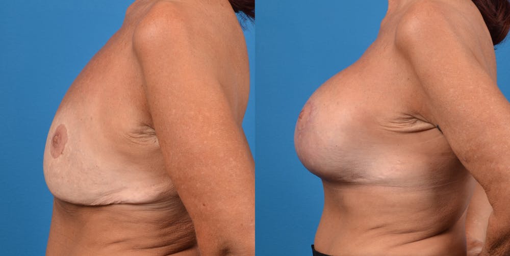 Breast Revision Before & After Gallery - Patient 14778924 - Image 3