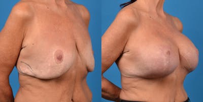 Breast Revision Before & After Gallery - Patient 14778924 - Image 4
