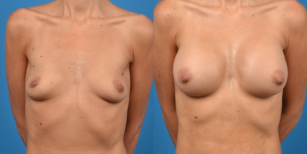 Breast Augmentation Before & After Gallery - Patient 14778929 - Image 1
