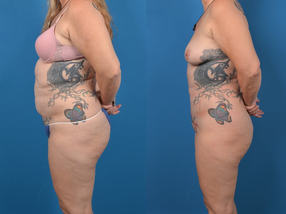 Abdominoplasty Before & After Gallery - Patient 14779077 - Image 2