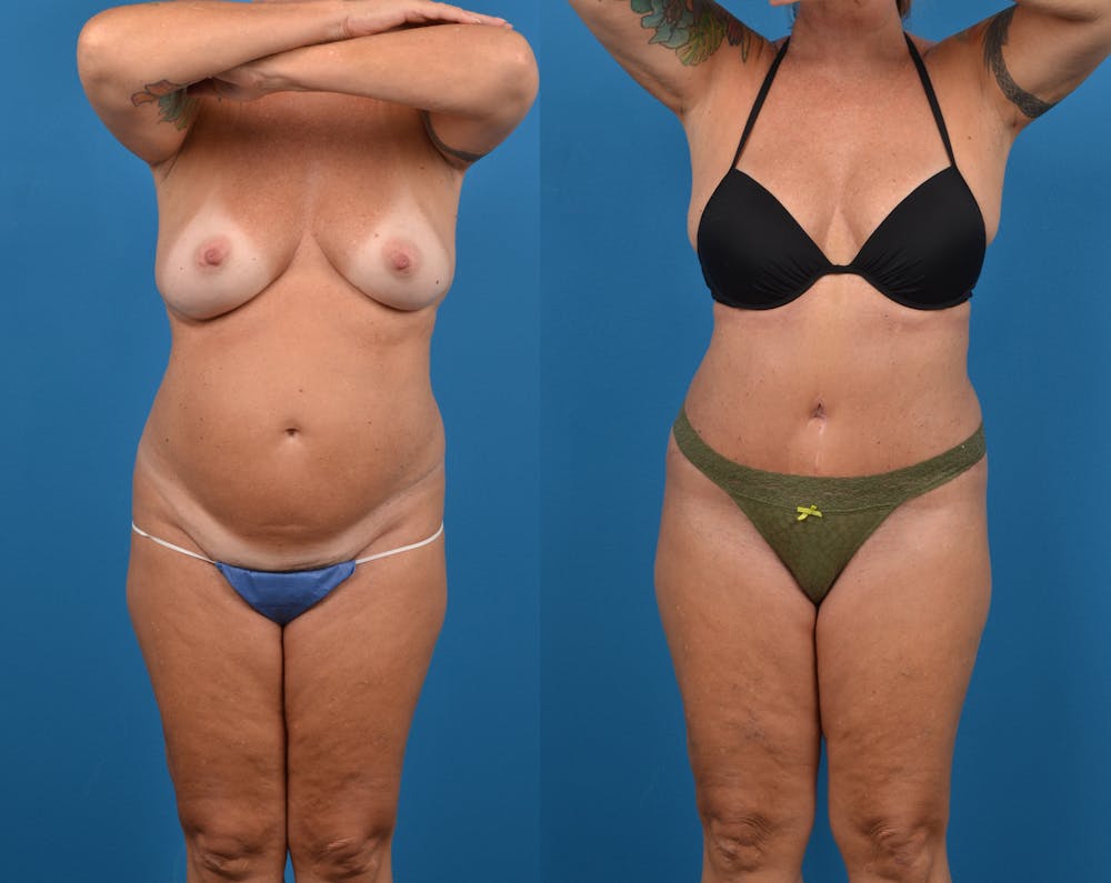 Abdominoplasty Before & After Gallery - Patient 14779091 - Image 1