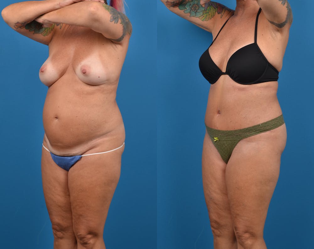 Abdominoplasty Before & After Gallery - Patient 14779091 - Image 2