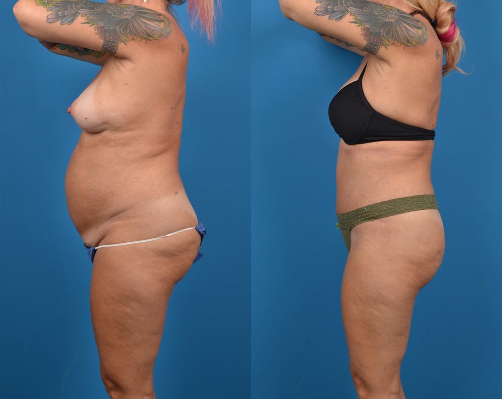 Abdominoplasty Before & After Gallery - Patient 14779091 - Image 3
