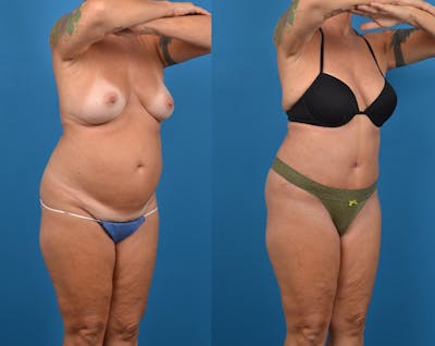 Abdominoplasty Before & After Gallery - Patient 14779091 - Image 4