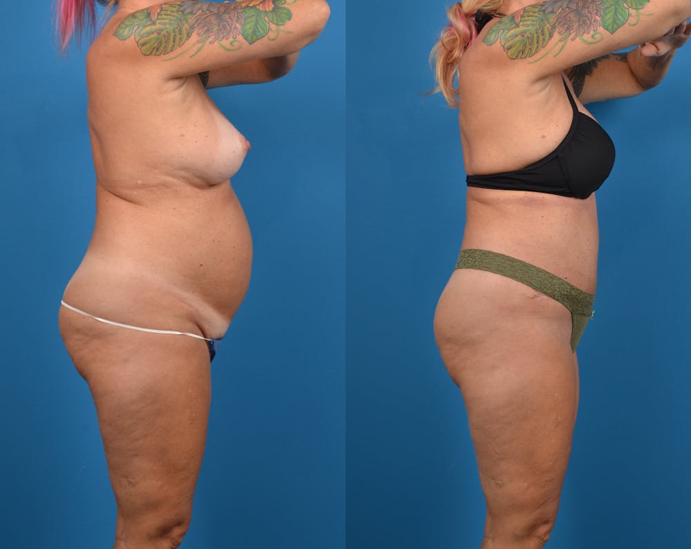 Abdominoplasty Before & After Gallery - Patient 14779091 - Image 5