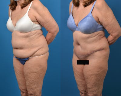 Abdominoplasty Before & After Gallery - Patient 14779095 - Image 2