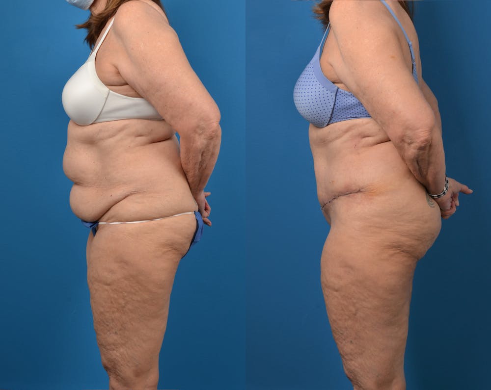 Abdominoplasty Before & After Gallery - Patient 14779095 - Image 3