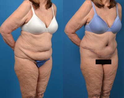 Abdominoplasty Before & After Gallery - Patient 14779095 - Image 4