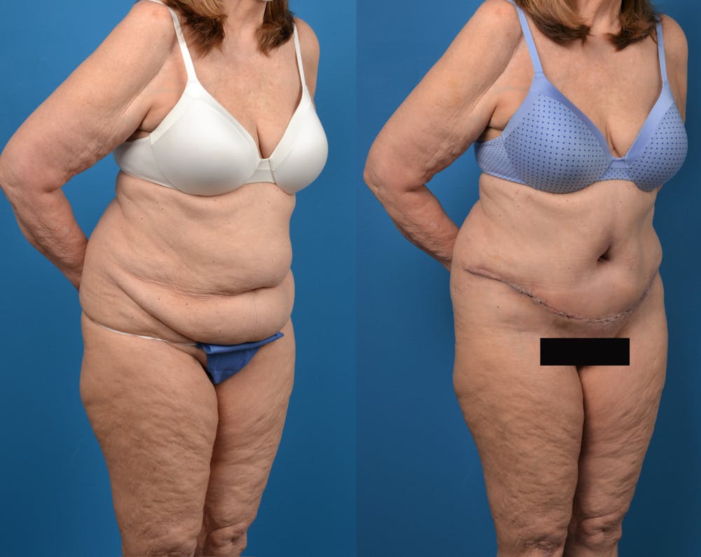 Abdominoplasty Before & After Gallery - Patient 14779095 - Image 4