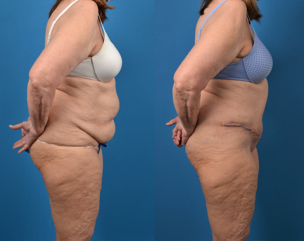 Abdominoplasty Before & After Gallery - Patient 14779095 - Image 5