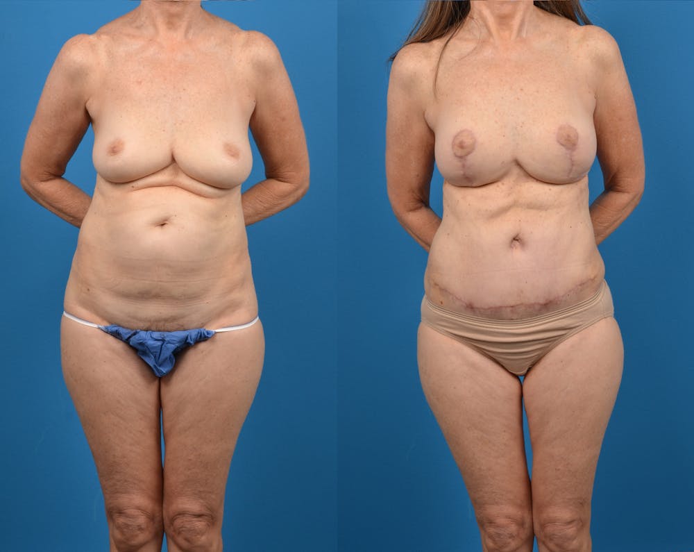 Mommy Makeover Before & After Gallery - Patient 14779113 - Image 1