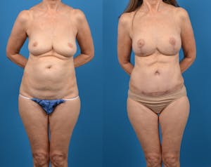 Mommy Makeover