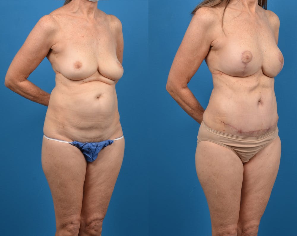 Abdominoplasty Before & After Gallery - Patient 14779107 - Image 2