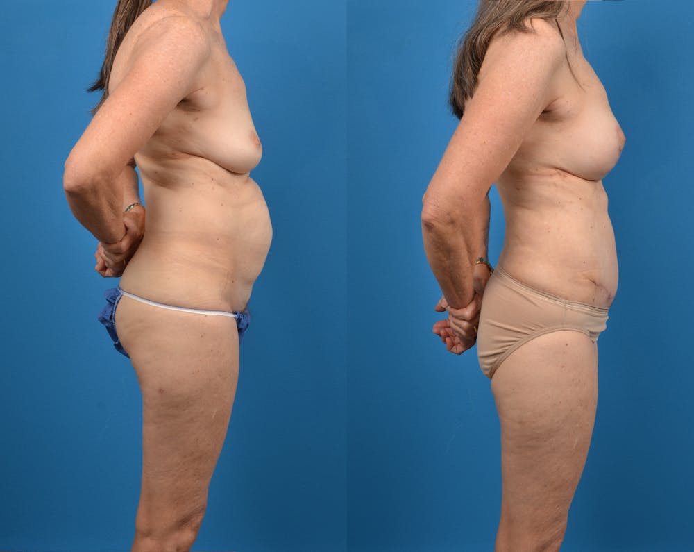 Abdominoplasty Before & After Gallery - Patient 14779107 - Image 3