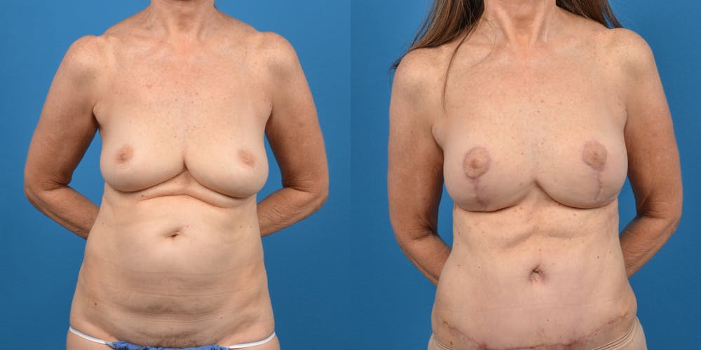 Breast Lift Before & After Gallery - Patient 14779114 - Image 1