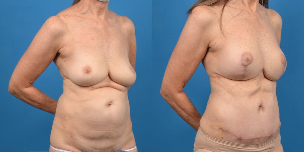 Breast Lift Before & After Gallery - Patient 14779114 - Image 2