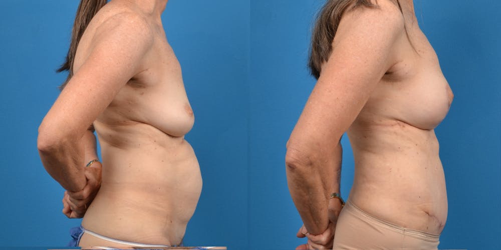 Breast Lift Before & After Gallery - Patient 14779114 - Image 3