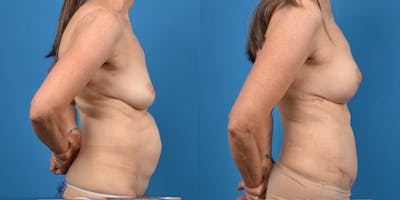 Mommy Makeover Before & After Gallery - Patient 14779113 - Image 6
