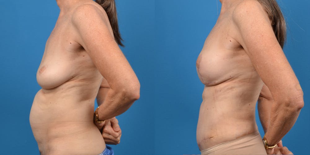 Breast Lift Before & After Gallery - Patient 14779114 - Image 4