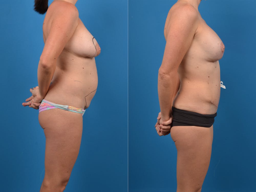 Abdominoplasty Before & After Gallery - Patient 14779120 - Image 1