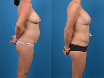Abdominoplasty Before & After Gallery - Patient 14779120 - Image 1