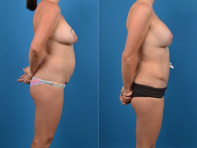 Mommy Makeover Before & After Gallery - Patient 14779121 - Image 1