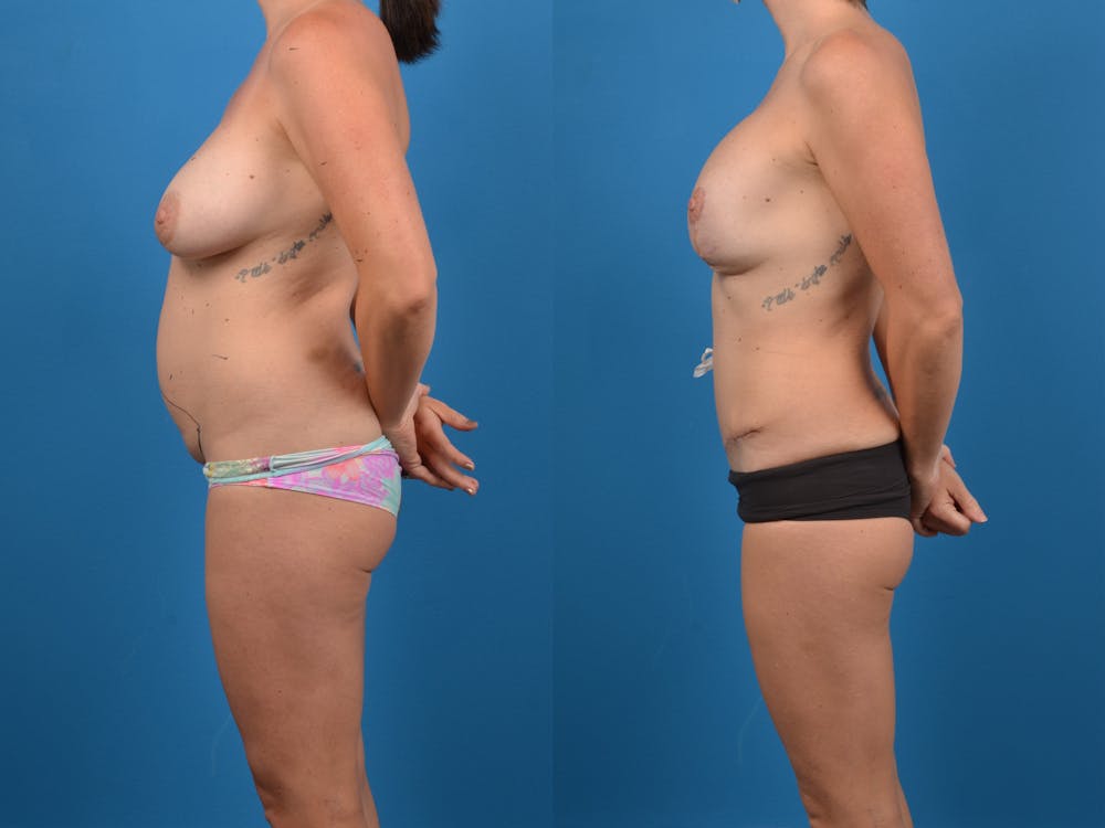 Abdominoplasty Before & After Gallery - Patient 14779120 - Image 2