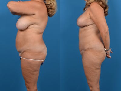 Abdominoplasty Before & After Gallery - Patient 14779138 - Image 2