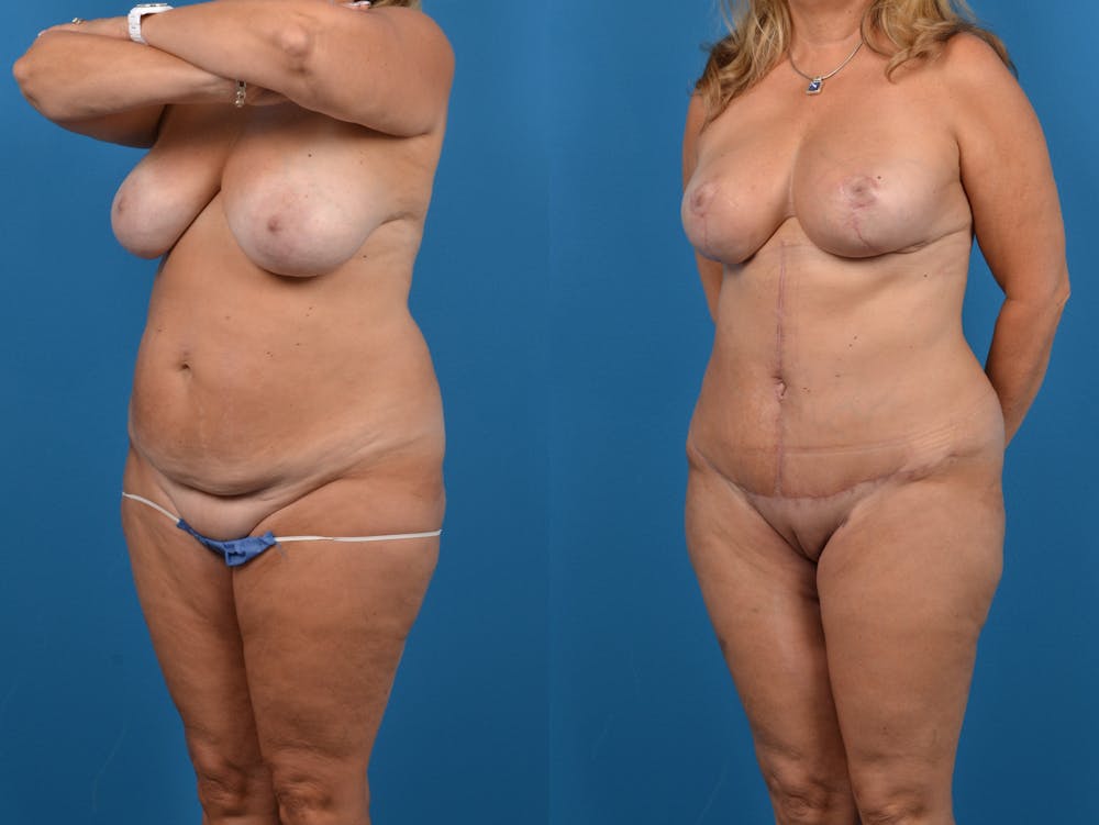 Mommy Makeover Before & After Gallery - Patient 14779137 - Image 3
