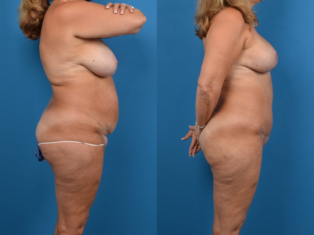Abdominoplasty Before & After Gallery - Patient 14779138 - Image 5