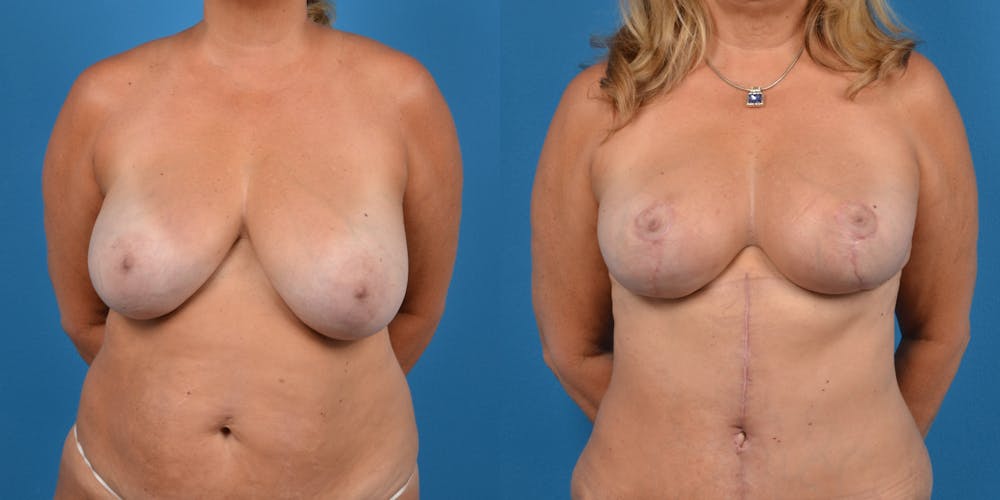 Mommy Makeover Before & After Gallery - Patient 14779137 - Image 6