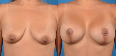 Breast Augmentation Before & After Gallery - Patient 14779160 - Image 1