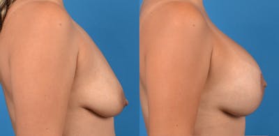 Breast Augmentation Before & After Gallery - Patient 14779160 - Image 2
