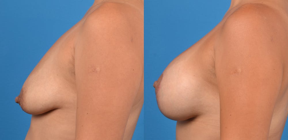 Breast Augmentation Before & After Gallery - Patient 14779160 - Image 3