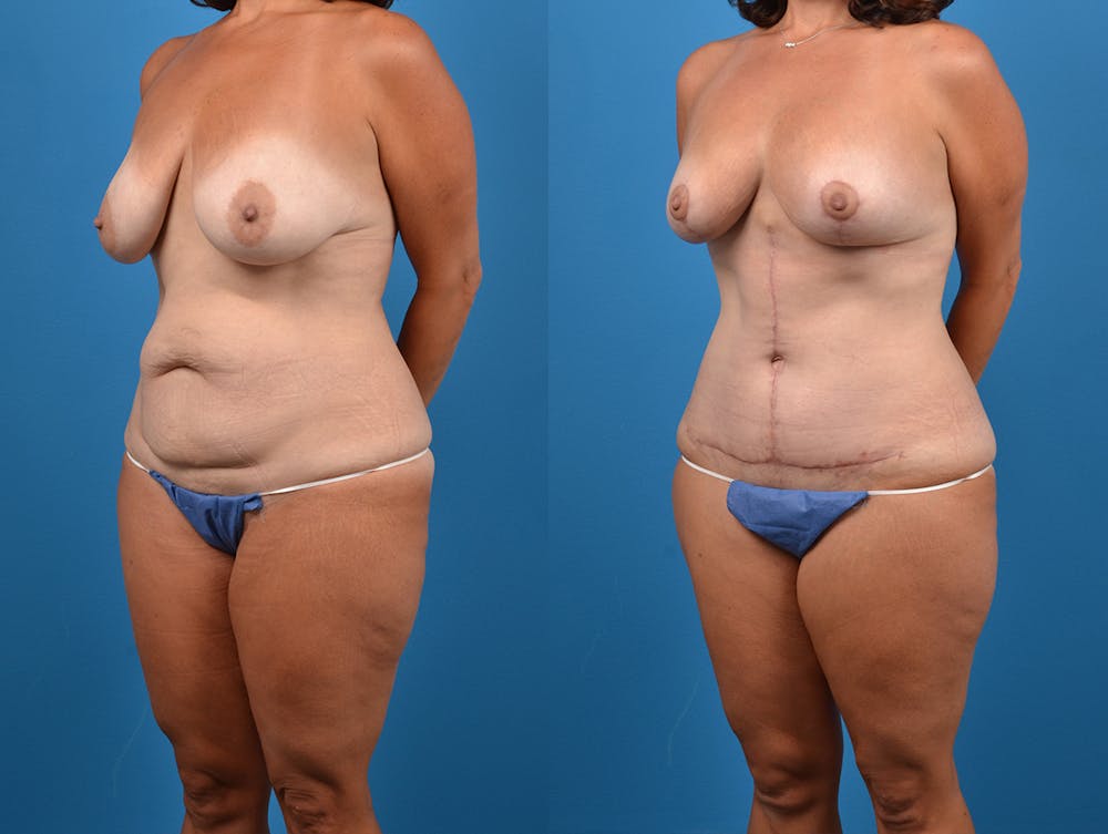 Post-Bariatric Surgery Before & After Gallery - Patient 14779180 - Image 2